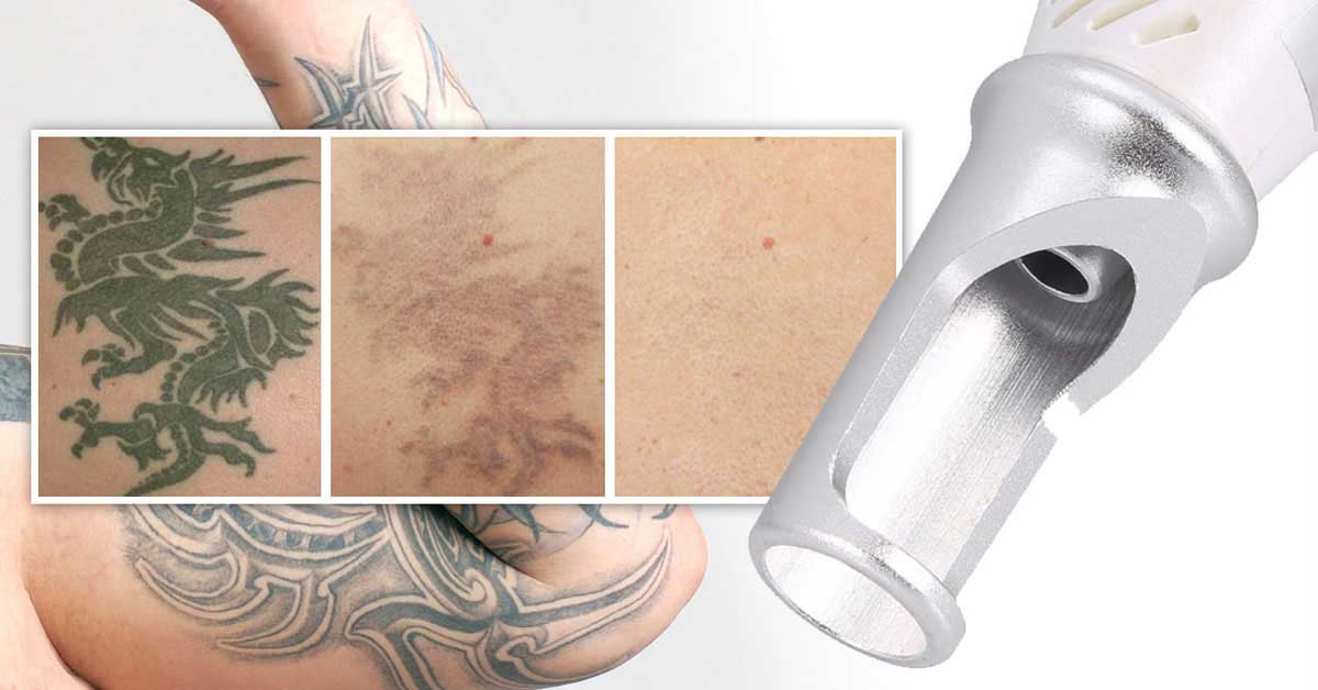 Picolaser tattoo removal pembroke pines