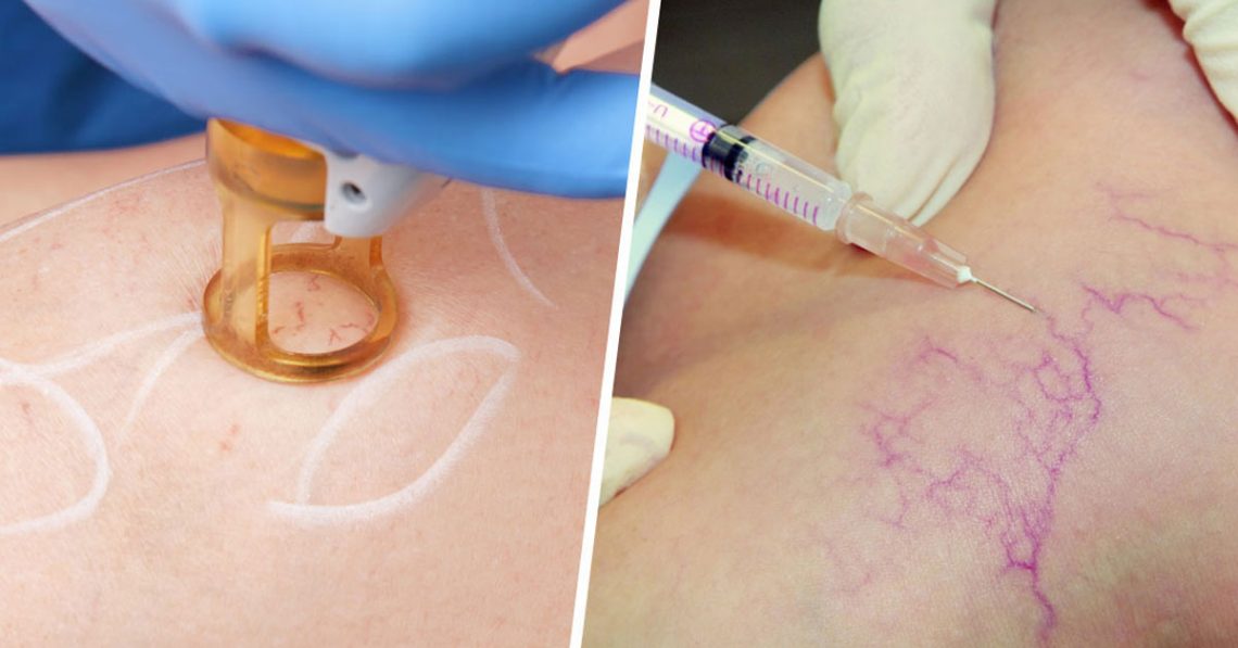 Spider vein removal pembroke pines